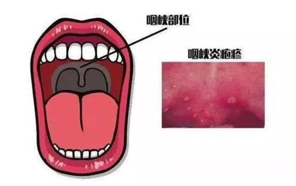 疱疹性咽峡炎_html_378003a0.jpg